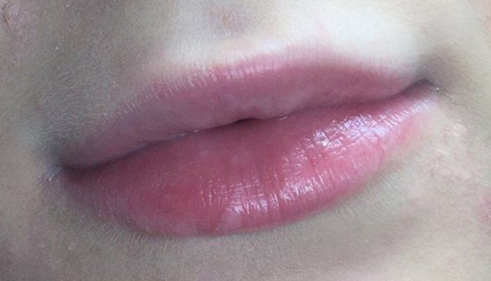 juvederm lips filler