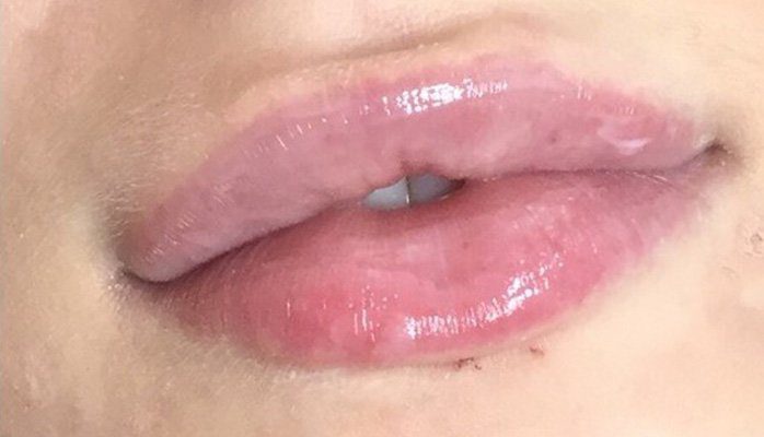 lip filler