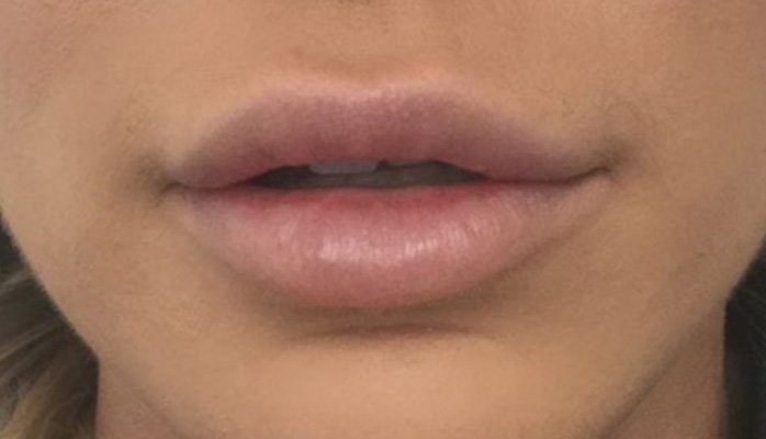 lip dermal filler