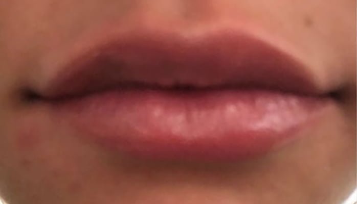lips filler
