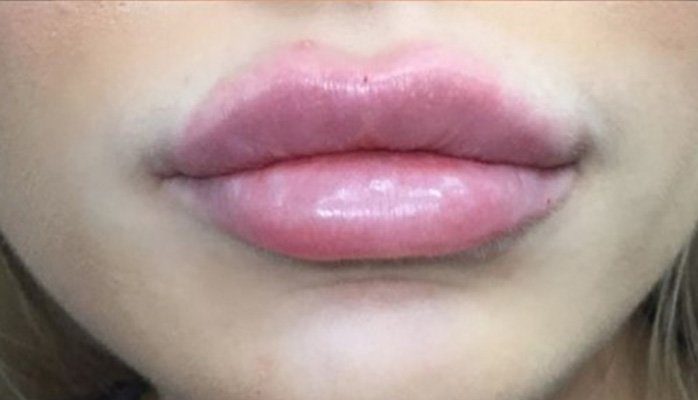 dermal filler lips injection