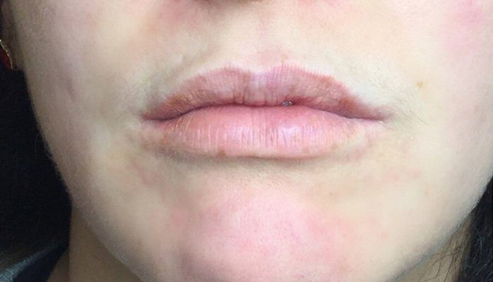 lip filler