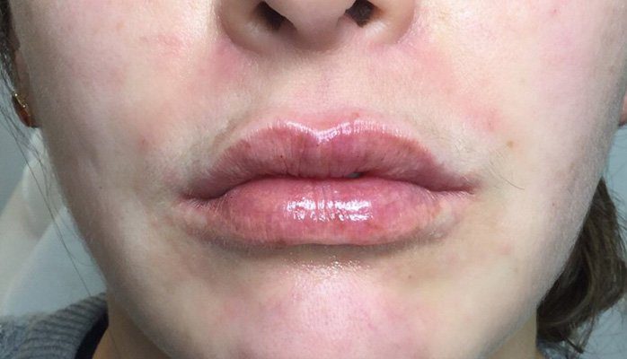 lip filler
