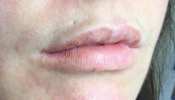 dermal filler lips