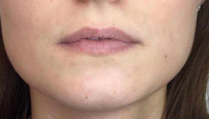 dermal filler lip