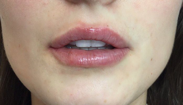 lip filler