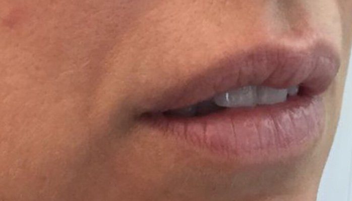 lip filler