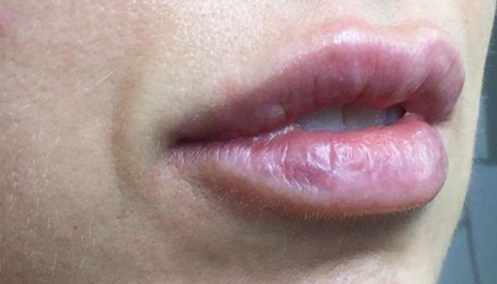 lip filler