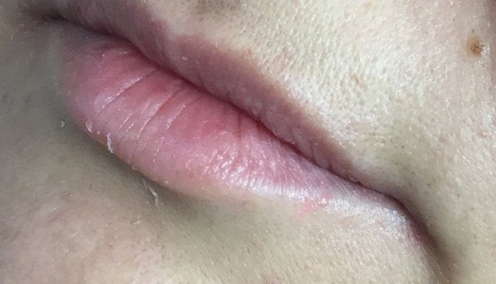 lip juvederm filler