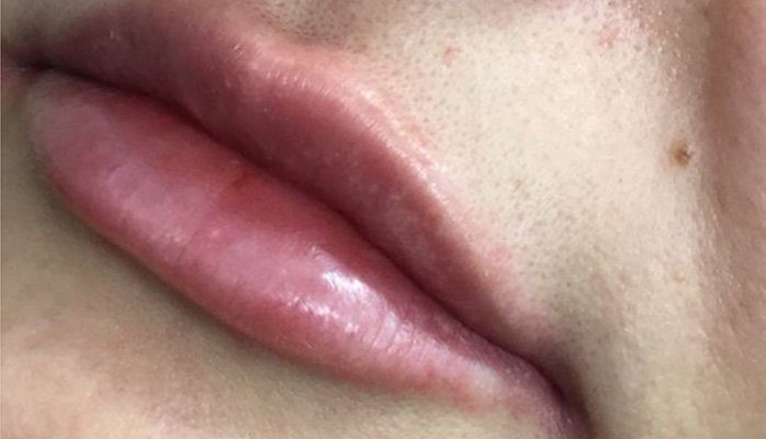 lip contour filler