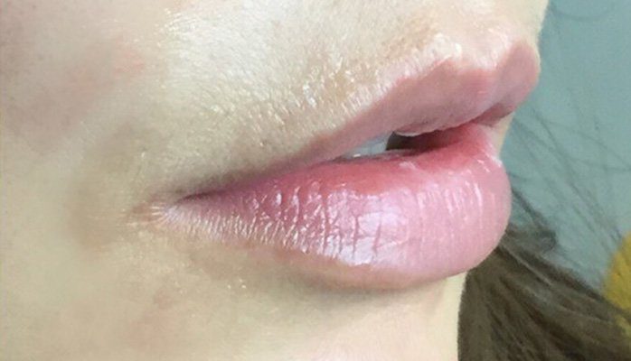 lip injection