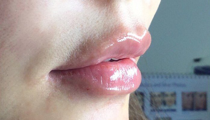 lip dermal filler