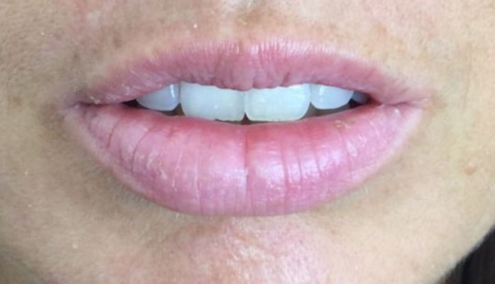 lips filler
