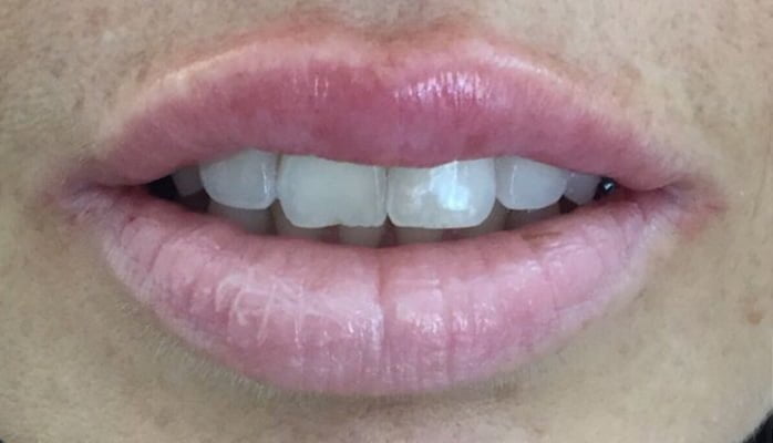 lips filler