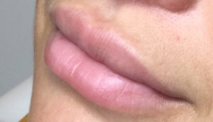 dermal filler lips injection