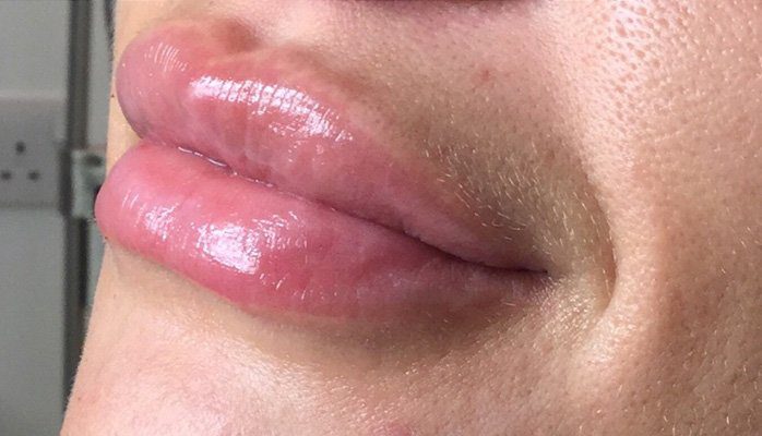 lips filler