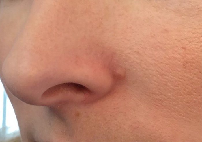 mole excision removal