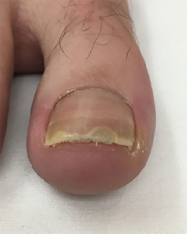 nail fungus laser