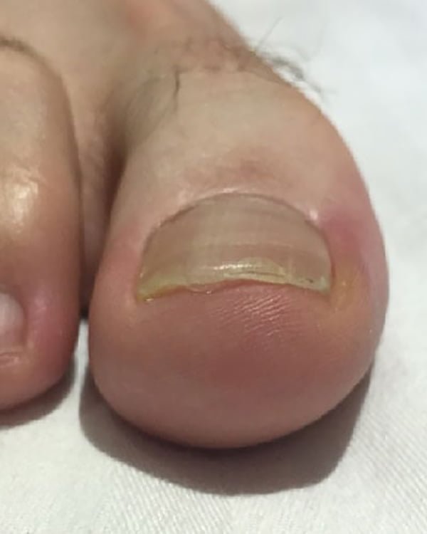nail fungus treatment