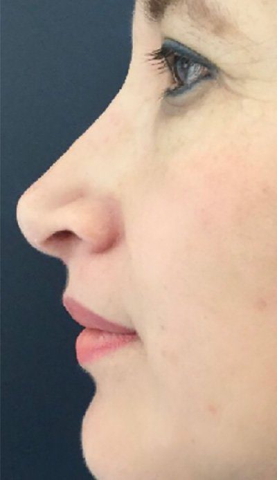 non surgical rhinoplasty