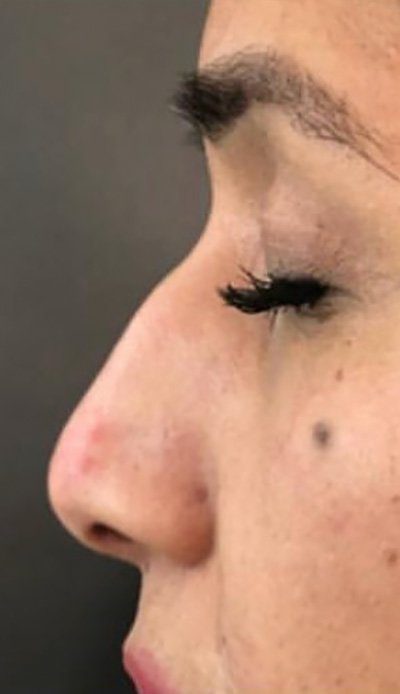 nose bump correction