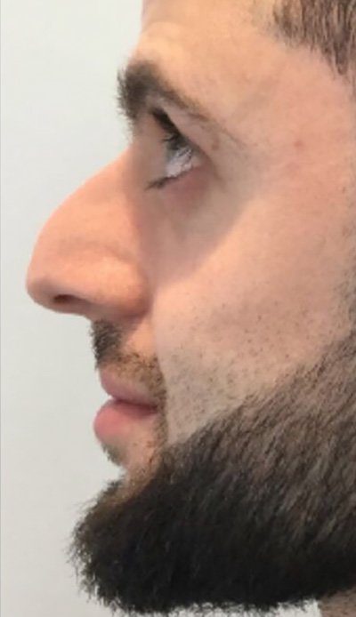 hook nose treatment with dermal filler injection