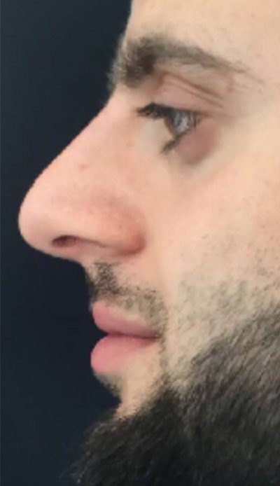 nose job with dermal filler injection