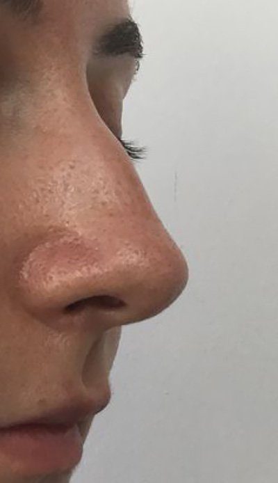 nose bump correction