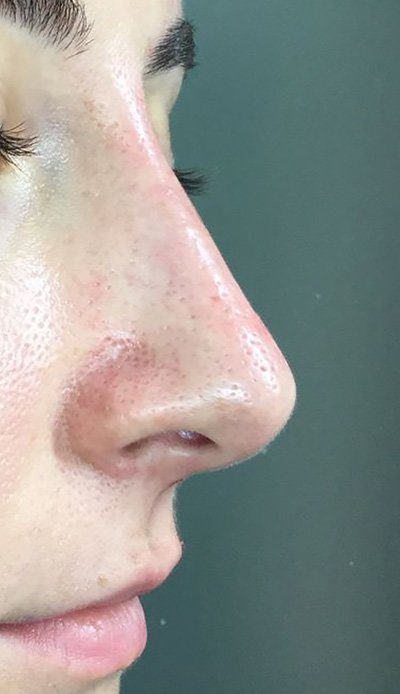 non surgical nose job