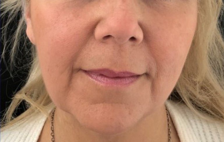 dermal fileer treatment