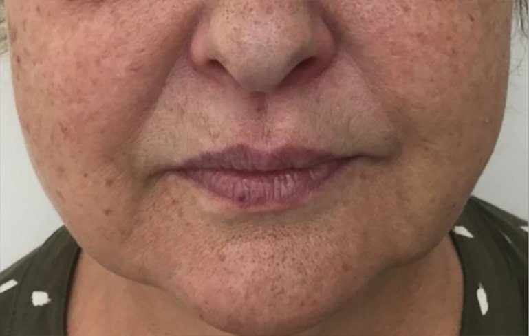 nose to mouth lines dermal filler injection