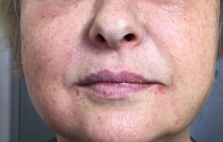 marionette lines dermal filler injection