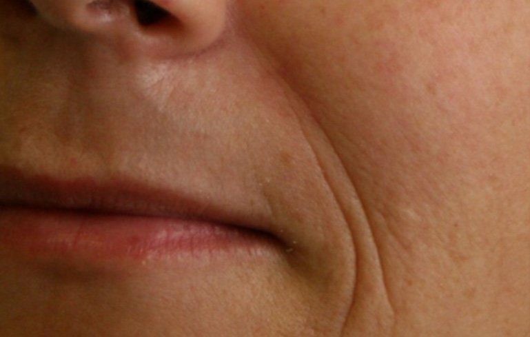 nose to mouth line dermal filler injection
