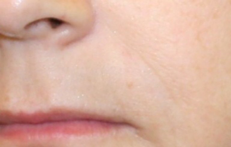 nose to mouth line treatment
