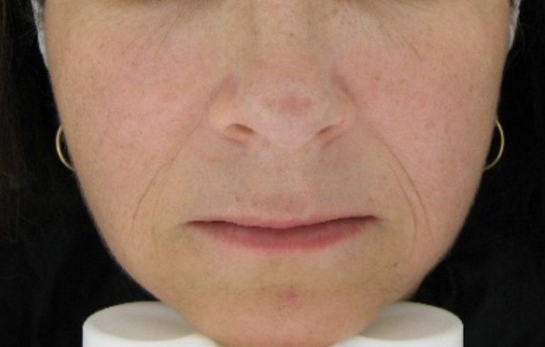 naso labial folds dermal filler injection