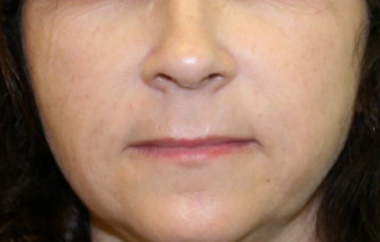 nose to moth line dermal filler injection