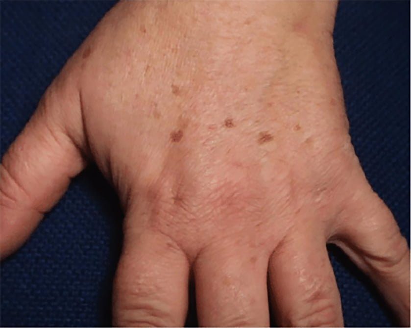 hand skin rejuvenation laser