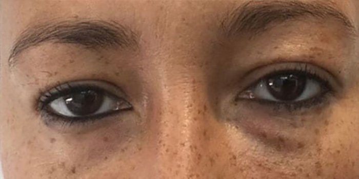 eye bag correction with dermal filler