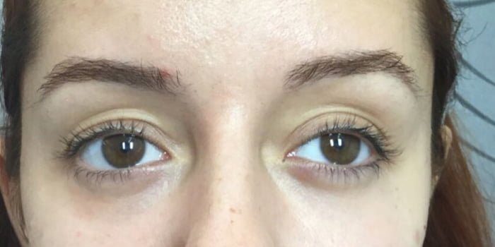 teosyal redensity 2 tear through filler