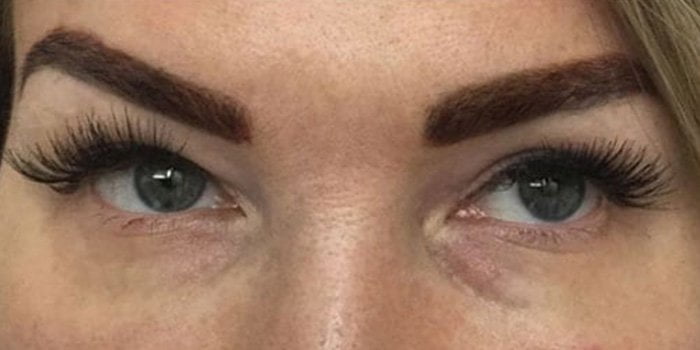 eye bag treatment with dermal filler
