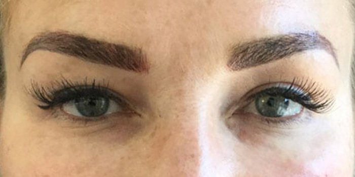 eye dark circle dermal filler injection