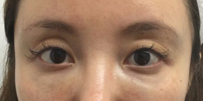 tear through filler treatment