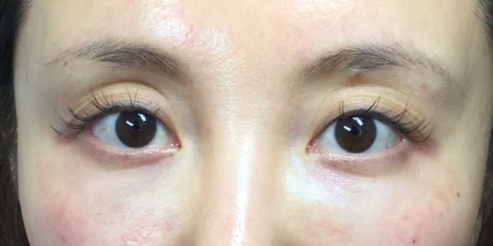 juvederm dermal filler injection for eye bag