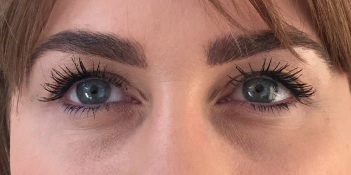 eye bag correction with dermal filler