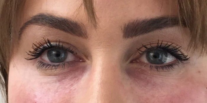 eye dark circle treatment with dermal filler