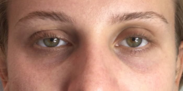eye dark circle hollow treatment with dermal filler tear through