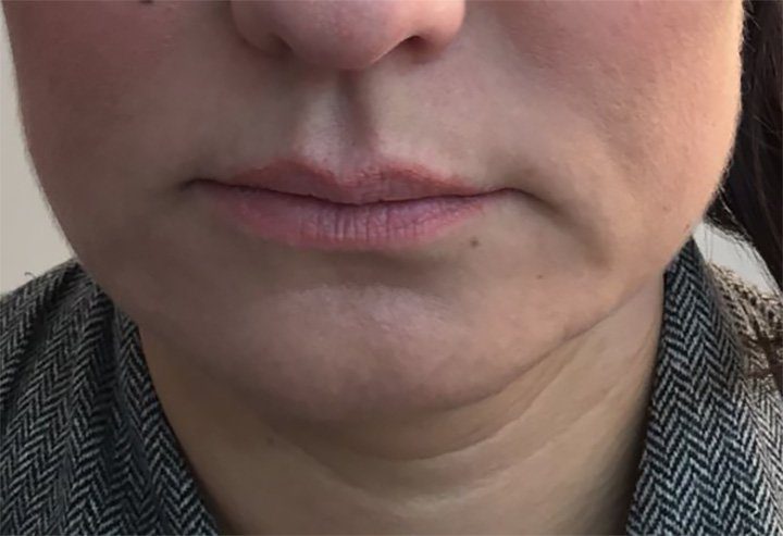 thread lift treatment