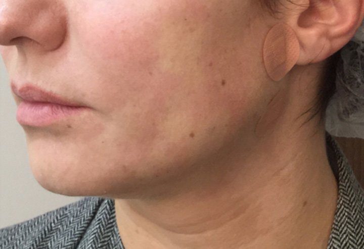 PDO thread lift treatment