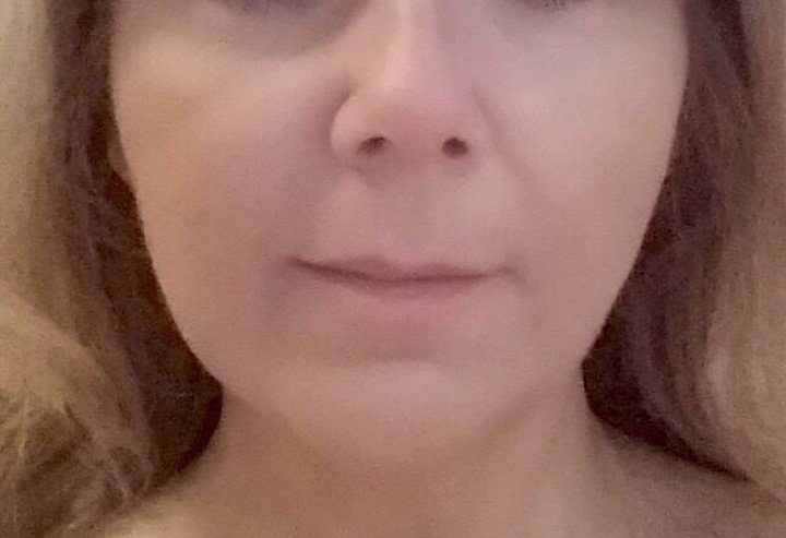 dermal filler treatment