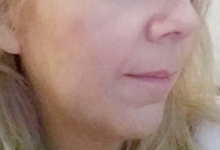 jaw line contouring with dermal filler injection